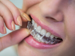 alinhadores transparentes