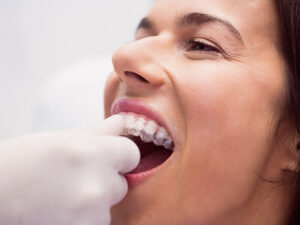 dentista colocando alinhador transparente na mulher