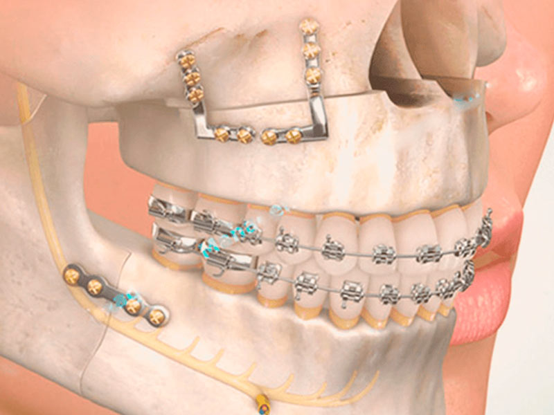 cirurgia ortognática