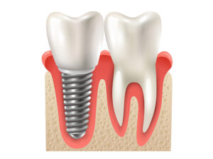 implantes dentários