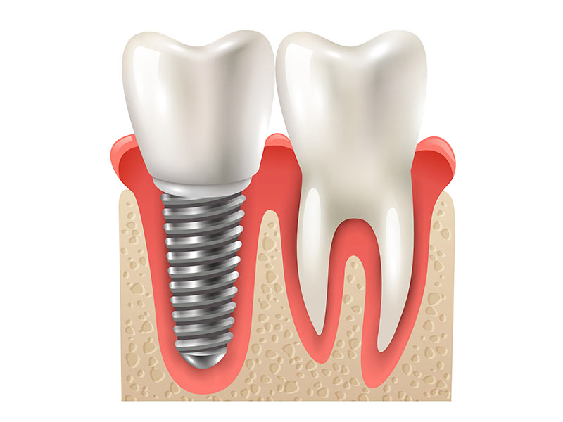 implantes dentários