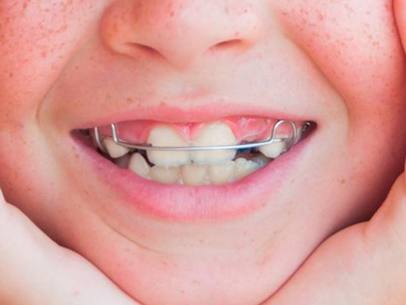 ortopedia funcional dos maxilares home